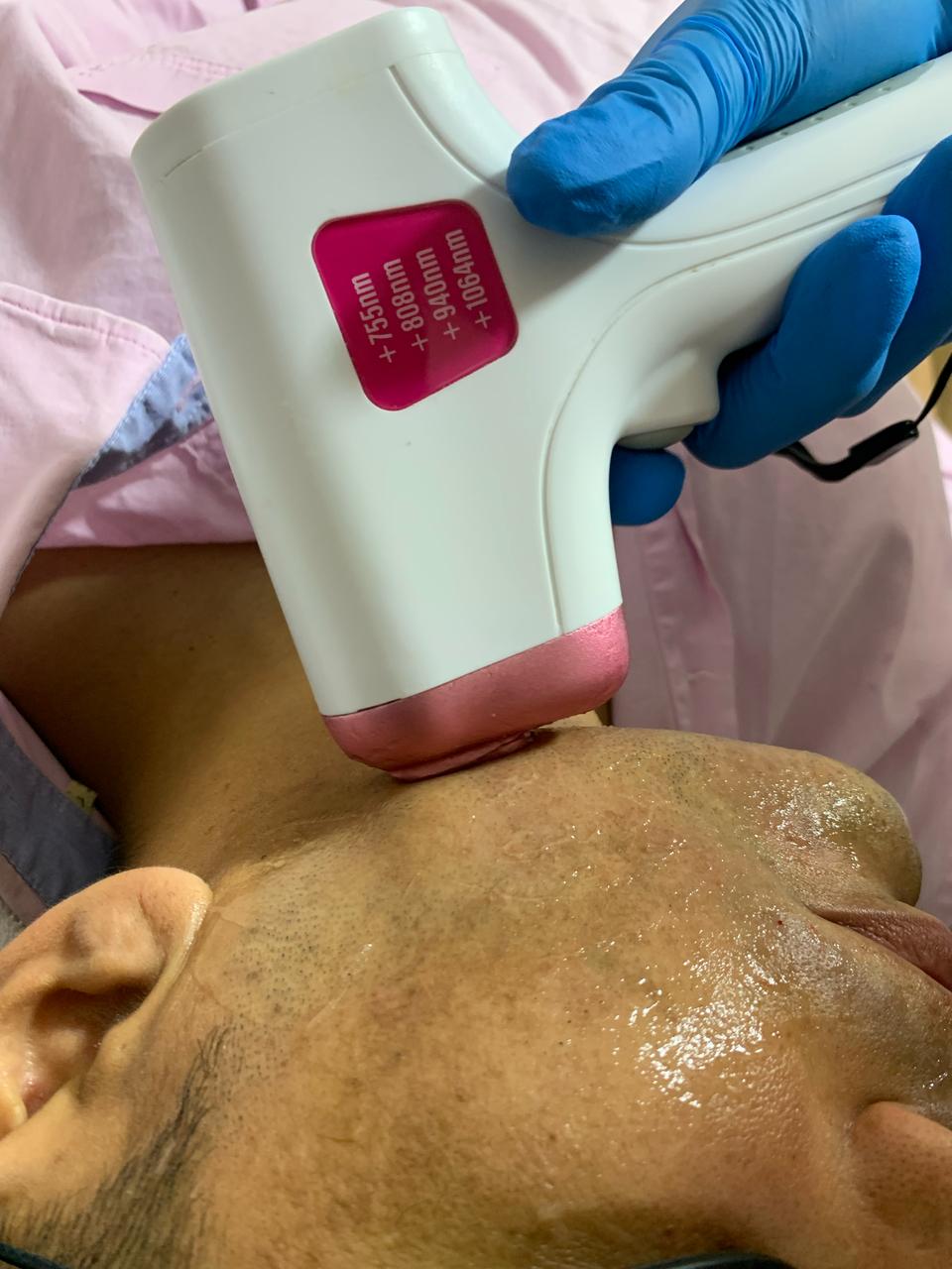 Cabezal cuatriláser de 4 longitudes de onda en Estética SanVi, San Vicente de Tagua Tagua